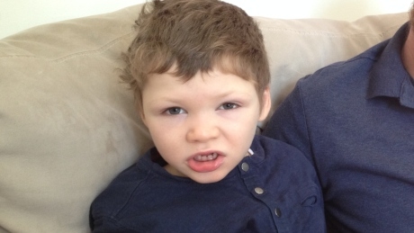 Cannabidiol reduces seizures in kids with severe form of epilepsy, trial shows