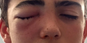 Suspects identified in egging that may have permanently injured teen