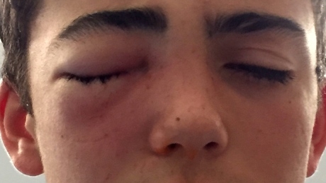 Suspects identified in egging that may have permanently injured teen