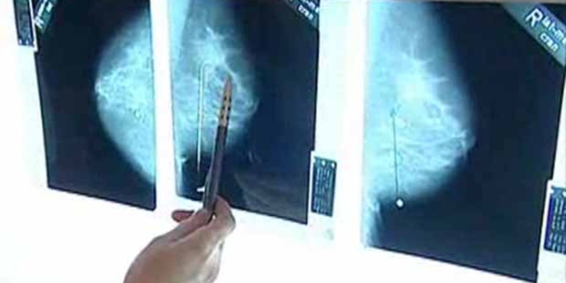 AHS, RCMP warn again about caller asking women to perform breast self-exams