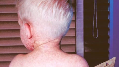 AHS warns of potential measles exposure in Calgary