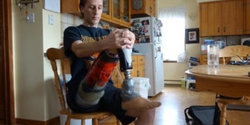 Amputees face complicated system getting help paying for artificial limbs