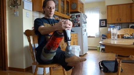 Amputees face complicated system getting help paying for artificial limbs