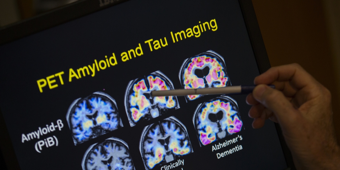 Senior’s weakness for scams may be warning sign of dementia