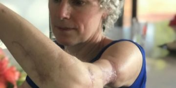 ‘They tore my muscles as if I was their prey’: Dog attack survivor wants negligent owners held responsible