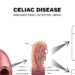 New study calls for screening of family members of celiac-disease patients