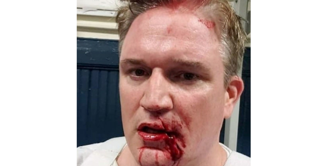 &lsquo;So… my face is a brick magnet’: NYPD lieutenant sports bloody face after violent clashes with George Floyd protesters