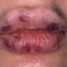 Lockdown lip fillers gone wrong: 'My lips went black'