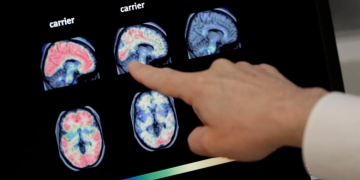 New Alzheimer's drug approved in U.S. despite concerns about effectiveness